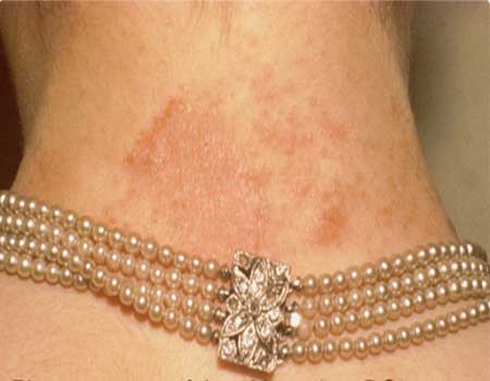 Penyebab Terjadinya Alergi Saat Mengenakan Perhiasan